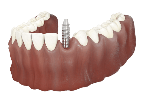Single dental implant restoring one missing tooth