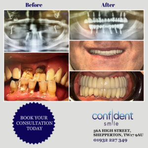 Full mouth rehabilitation before and after