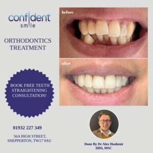 Orthodontics treatment before and after