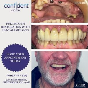Full mouth restoration with dental implants