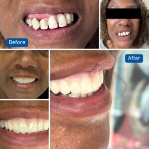 Cosmetic smile transformation before and after
