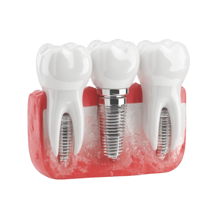 Multiple Teeth or Small Bridges