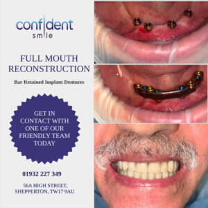 Full mouth reconstruction with bar retained implant dentures