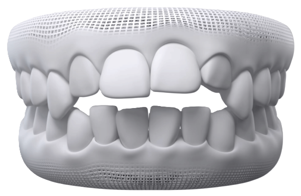 Open Bite — Invisalign can help
