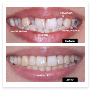 Invisalign before and after — Case 3