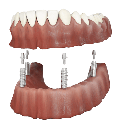 Implant-retained lower denture on four implants