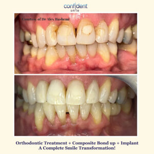 Orthodontic treatment, composite bonding and implant transformation