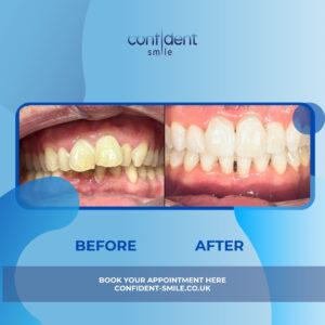 Before and after smile transformation