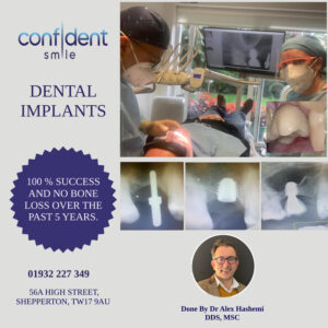 Dental implants case with 100% success rate