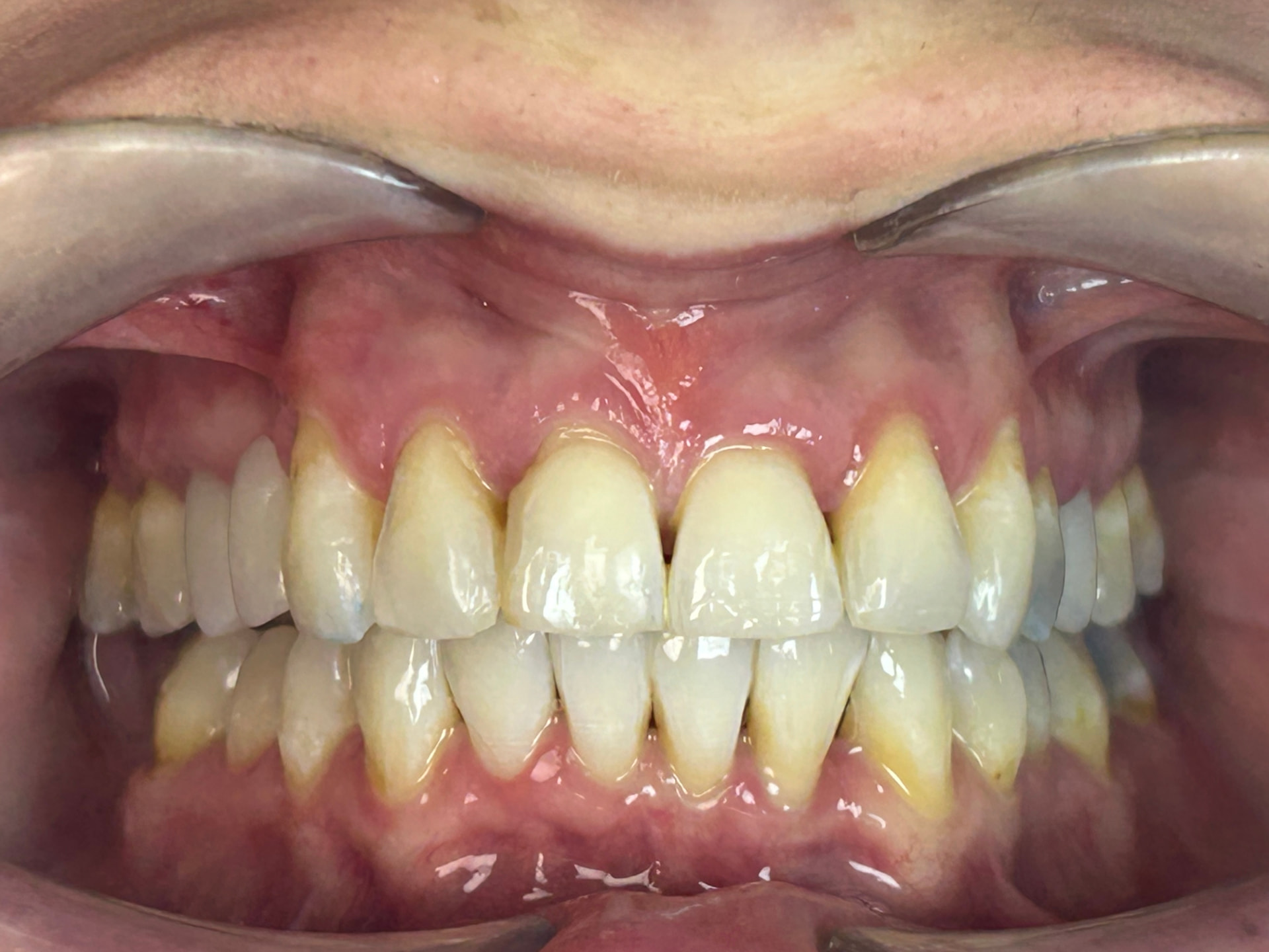 Close-up of teeth after treatment at Confident Smile Shepperton