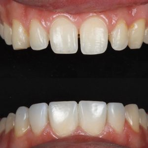 Composite bonding in Shepperton — before and after case 1