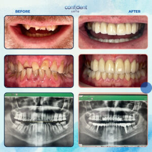 Full mouth restoration before and after with X-rays