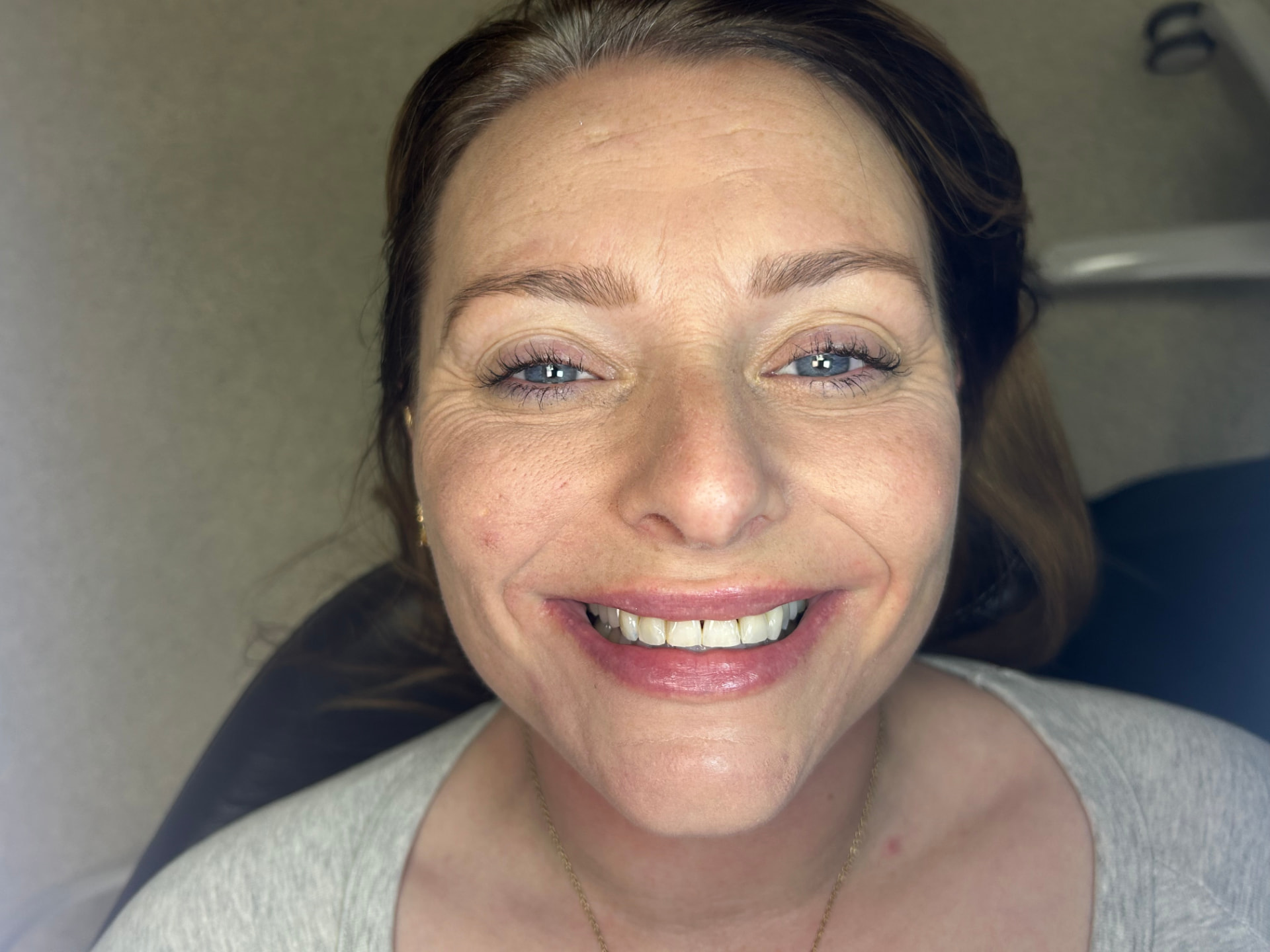 Patient's smile after treatment at Confident Smile Shepperton