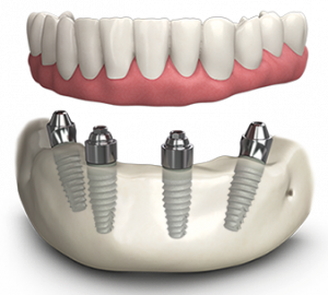 All on 4 lower jaw diagram — four implants supporting a full arch bridge
