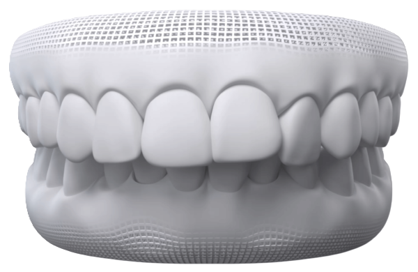 Overbite — Invisalign can help