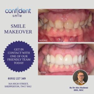 Smile makeover before and after