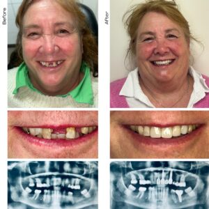 Full mouth rehabilitation before and after with X-rays