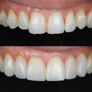 Composite bonding in Shepperton — before and after case 2
