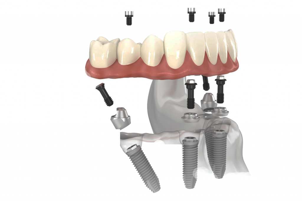 All on 4 dental implants diagram — four titanium implants supporting a full arch