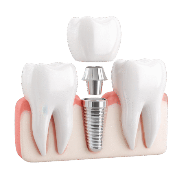 Single Tooth Replacement