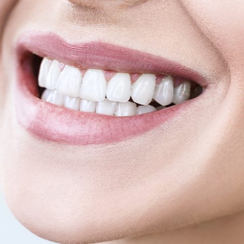 Teeth Whitening in Shepperton at Confident Smile