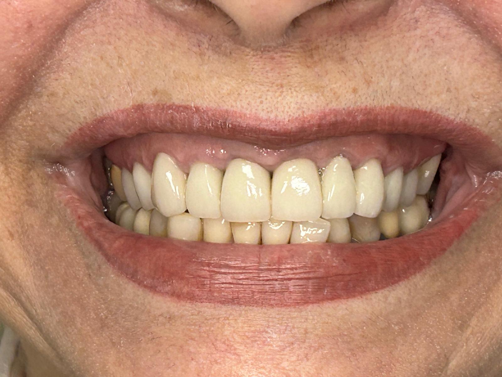 Close-up of a patient's teeth after treatment at Confident Smile Shepperton