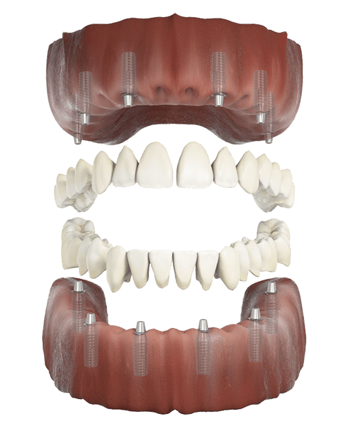 All-on-4 / All-on-6 full arch dental implants