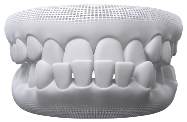 Underbite — Invisalign can help