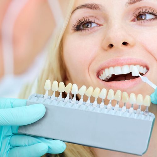 Porcelain Veneers in Shepperton at Confident Smile