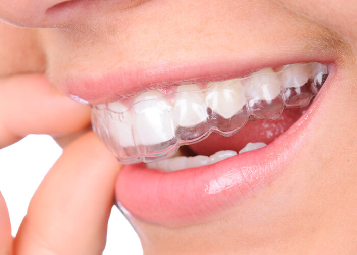 Close-up of clear Invisalign aligner in place