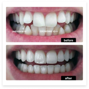 Invisalign before and after — Case 1