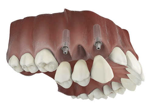 Two dental implants supporting a bridge in the upper jaw