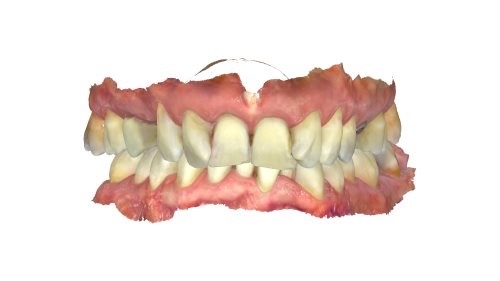Close-up of teeth before treatment at Confident Smile Shepperton