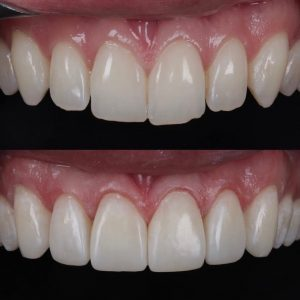 Composite bonding in Shepperton — before and after case 4