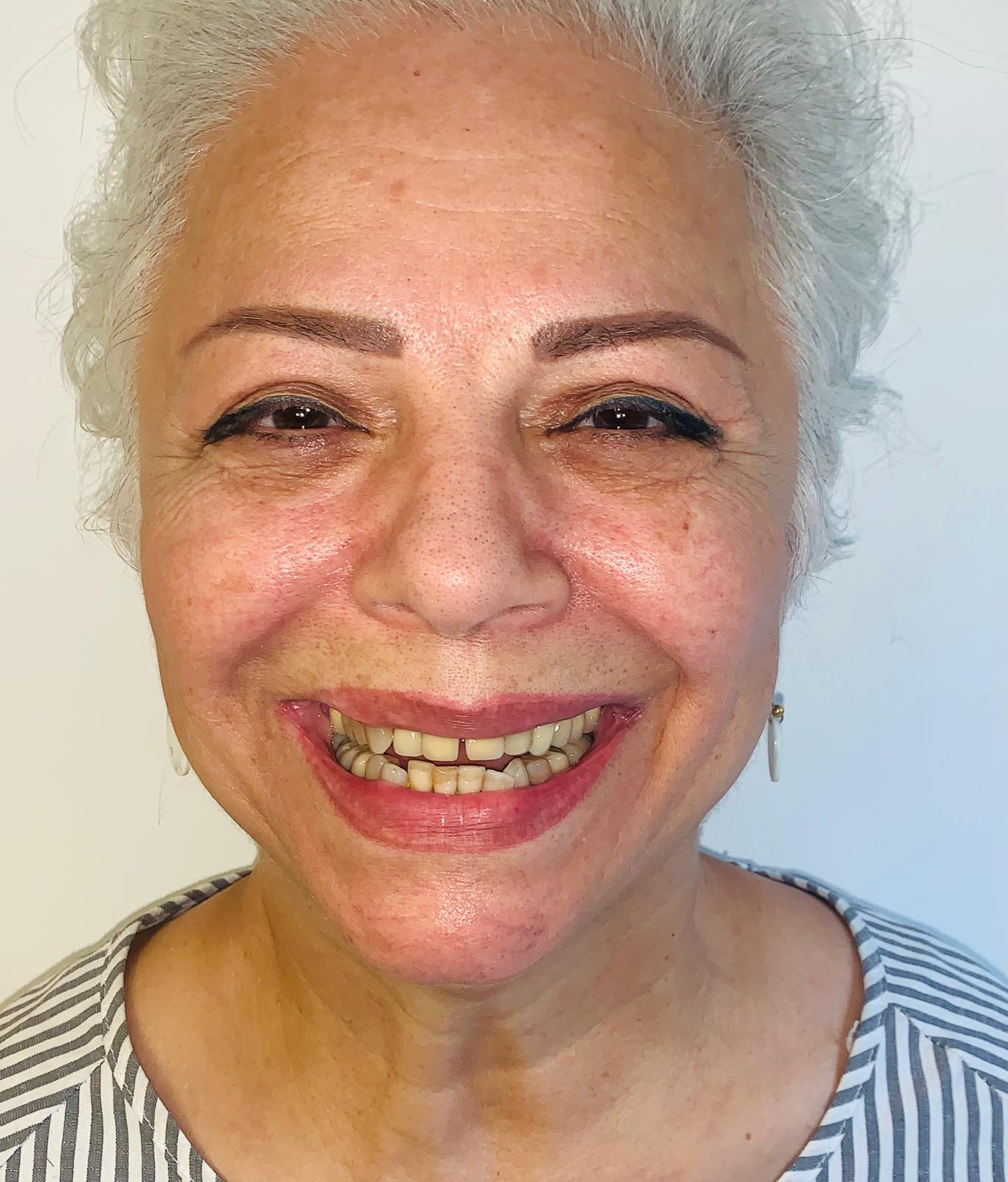 Patient's smile before treatment at Confident Smile Shepperton