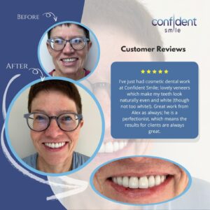 Cosmetic veneers before and after with customer review