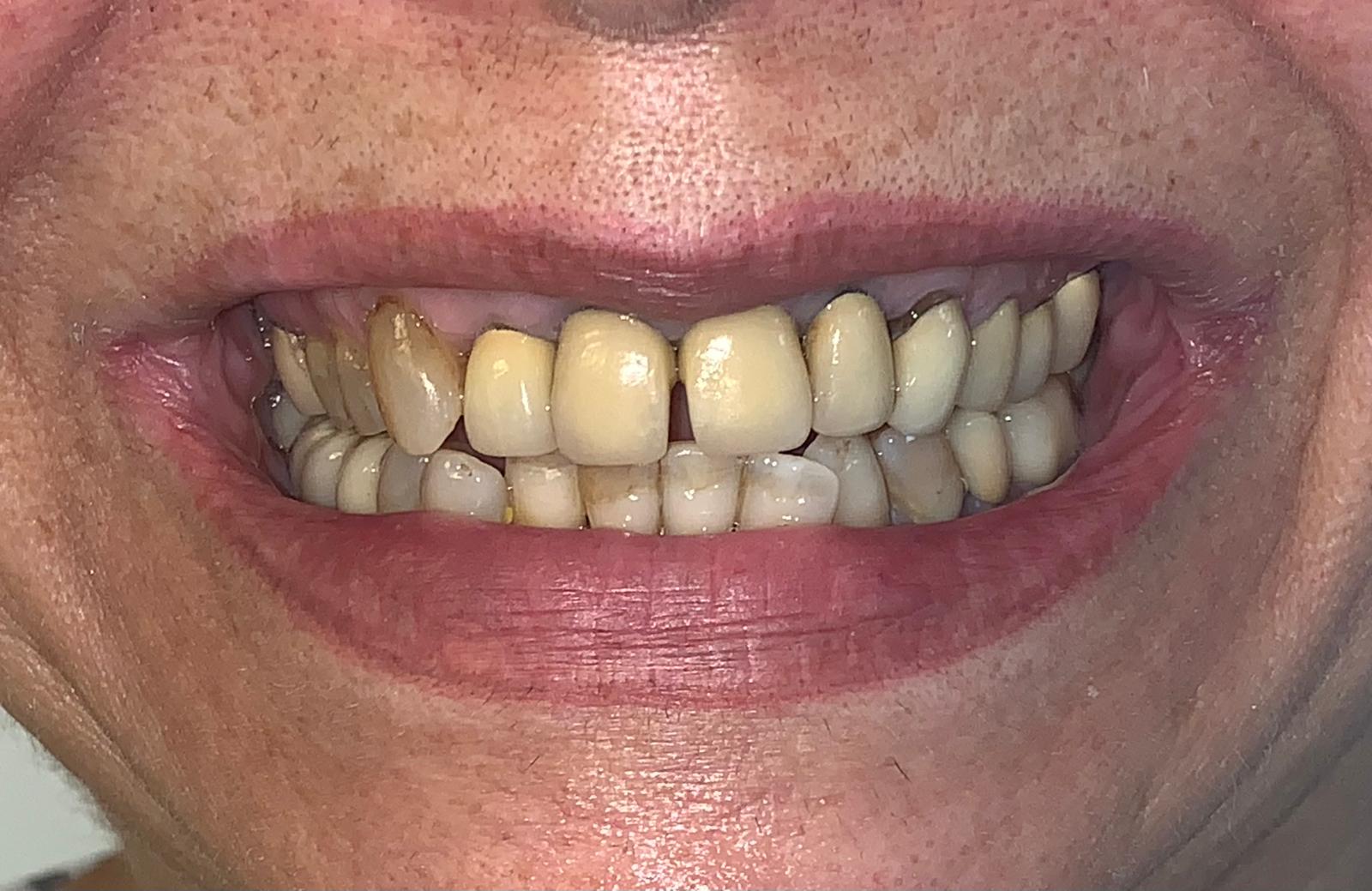 Close-up of a patient's teeth before treatment at Confident Smile Shepperton