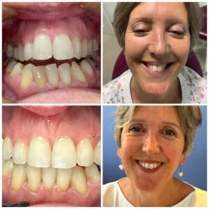Cosmetic dentistry before and after