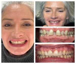 Smile transformation before and after