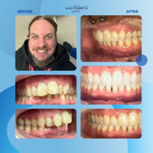 Before and after smile transformation