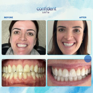 Smile makeover before and after
