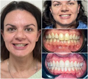 Orthodontic smile transformation before and after