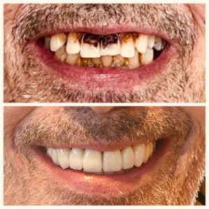 Before and after smile makeover