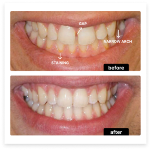 Invisalign before and after — Case 2