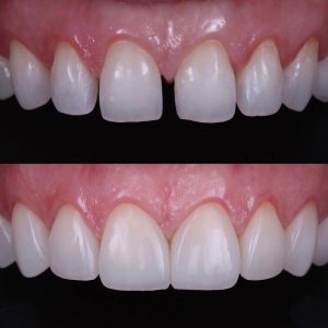 Composite bonding in Shepperton — before and after case 3
