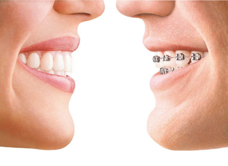 Invisalign clear aligners vs traditional metal braces