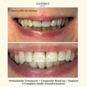 Orthodontic treatment, composite bonding and implant transformation