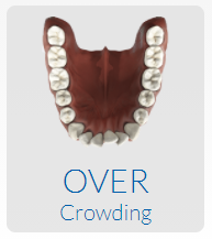 Overcrowded Teeth