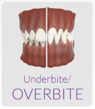 invisalign for underbite and overbite teeth forest hill