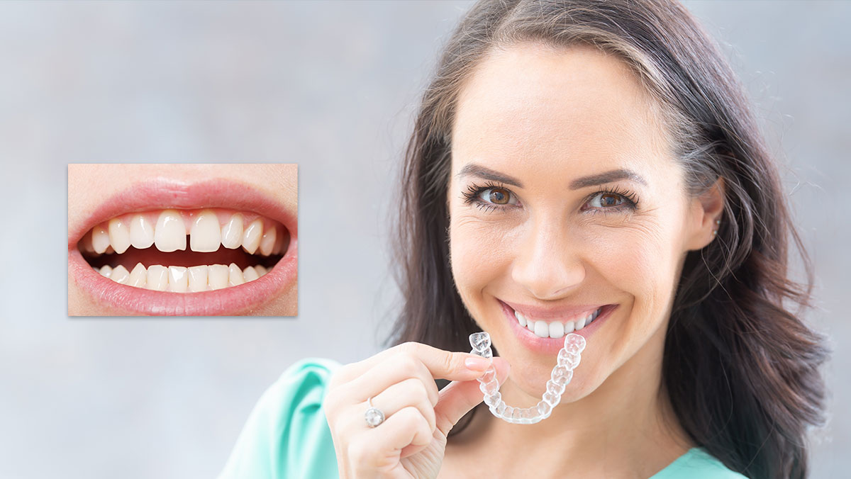 Invisalign Clear Braces Treatment for gap teeth in NYCDr. Jacquie